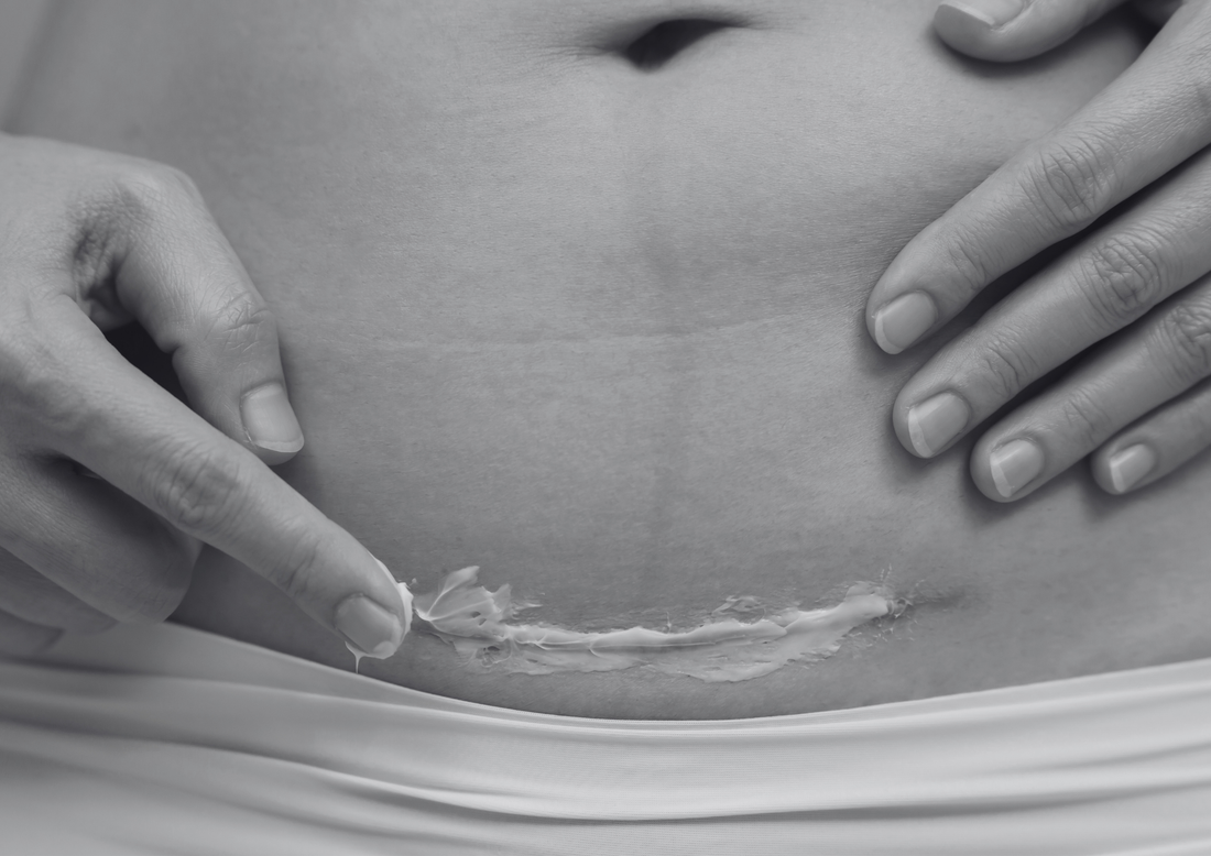 Wat je lichaam écht nodig heeft na een keizersnede”